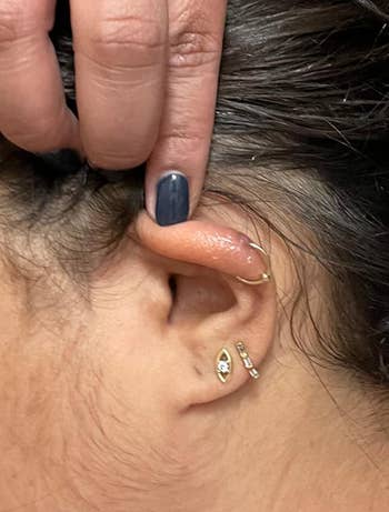 same reviewer's ear after daily use of keloid treatment