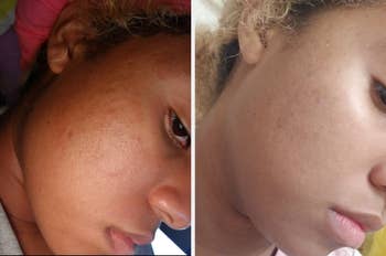 Before and after of reviewer with acne that's less inflamed in the after pic 