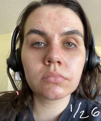 Person with acne and Date written on photo: 1/26