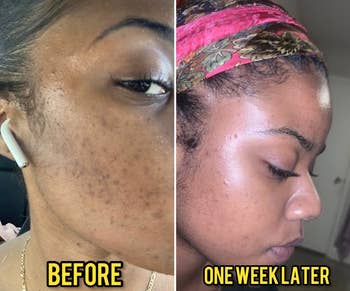 Reviewer with many dark spots and acne spots in the first pic and with much clearer skin a week after using the serum set