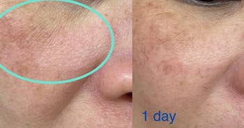 Close-up of facial tegument  examination  showing reduced redness and texture betterment  aft  1  time  of treatment