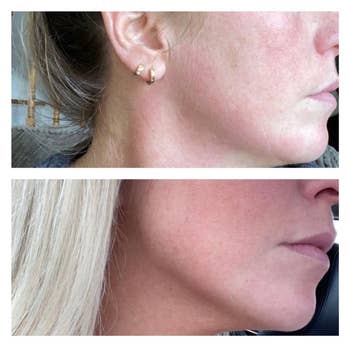 A reviewer's jaw before and after using the gua sha. Their jawline is much more defined after.