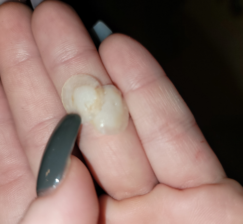 reviewer holding two acne patches in the palm of hand showing all the gunk extracted