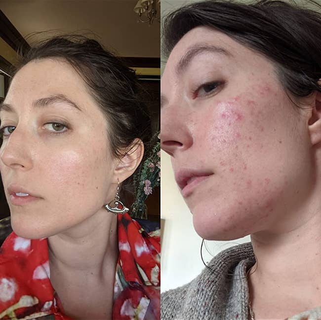 Reviewer before and after using CeraVe showing skin with blemishes then clear skin after