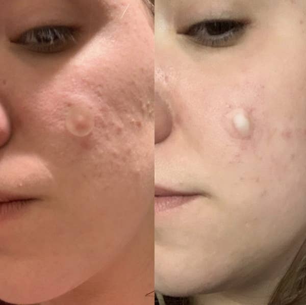 reviewer's photo of patch first applied and then after showing all the gunk from the pimple in the patch