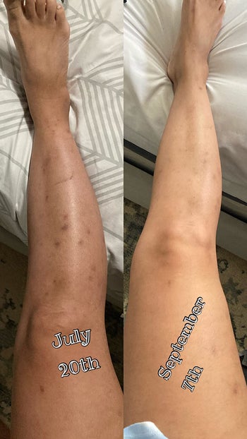 reviewer before and after photos showing their leg covered in mosquito bite scars, and then looking much clearer a few months later
