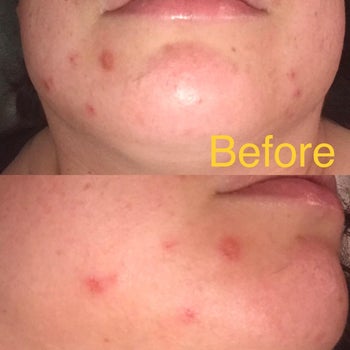 Reviewer before using TruSkin retinol serum, with blemishes on their chin and jaw