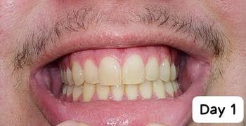 before image of a reviewer with yellow teeth
