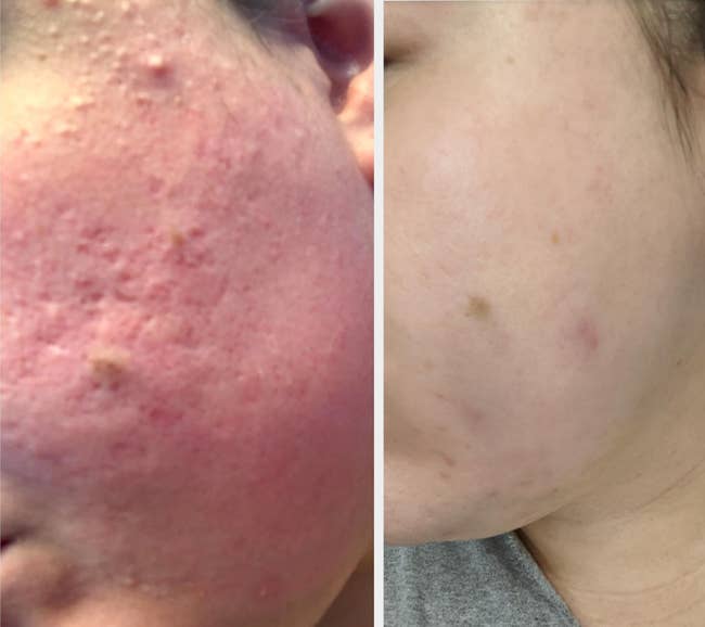 before/after of skin looking less red and inflamed after using the retinol serum