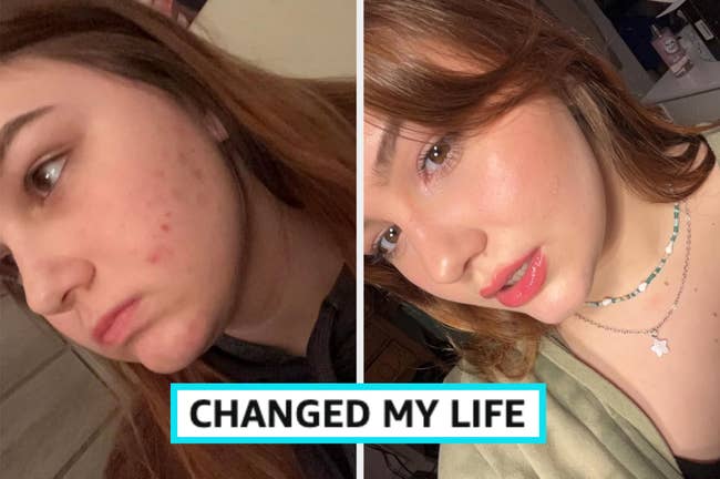 Side-by-side images of a woman with acne before and clearer skin after using a skincare product. The text reads: