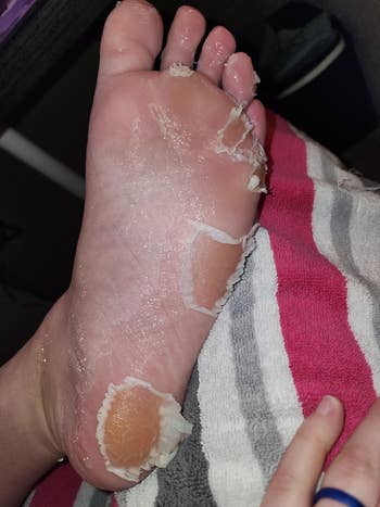 Close-up of a ft undergoing a peeling treatment, with disposable tegument shedding. A striped towel is partially disposable underneath
