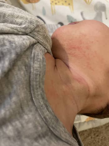 before photo of a child's neck with a red eczema rash on it