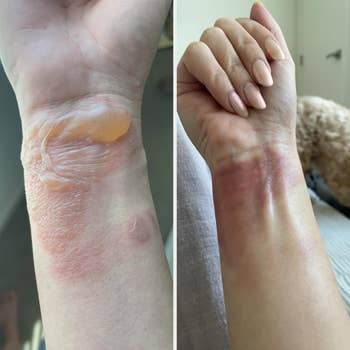 Two side-by-side images showing a wrist with irritated skin. Left representation  has ointment applied; the close    representation  shows tegument  healing without ointment