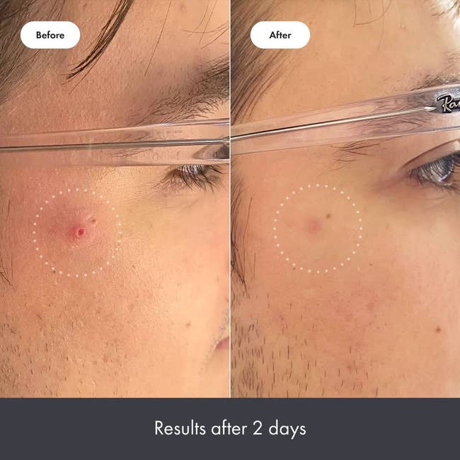 before and after images of a model with a blemish that looks healed after two days