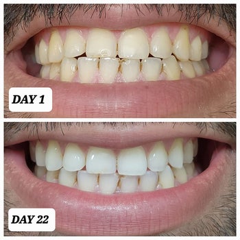 Reviewer at day 0 and day 22 showing the strips noticeably whitened their yellow teeth