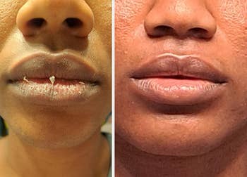 Before and after close-up of lips: left with chapped skin, right with smooth, hydrated appearance