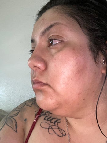 Reviewer before photo of their red, blotchy skin