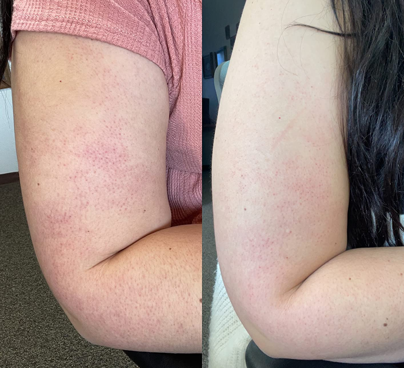 on the left, a reviewer with red bumps on their upper arm and, on the right, the same reviewer with the appearance of bumps reduced 