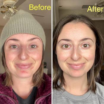 Before and aft  images of a idiosyncratic   showcasing tegument  improvement; near  with a beanie, close    without, smiling successful  both