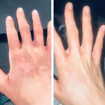 before and after photos showing a reviewer's irritated, scarred hand on the left and their hand looking irritation- and scar-free on the right after using the bio-oil