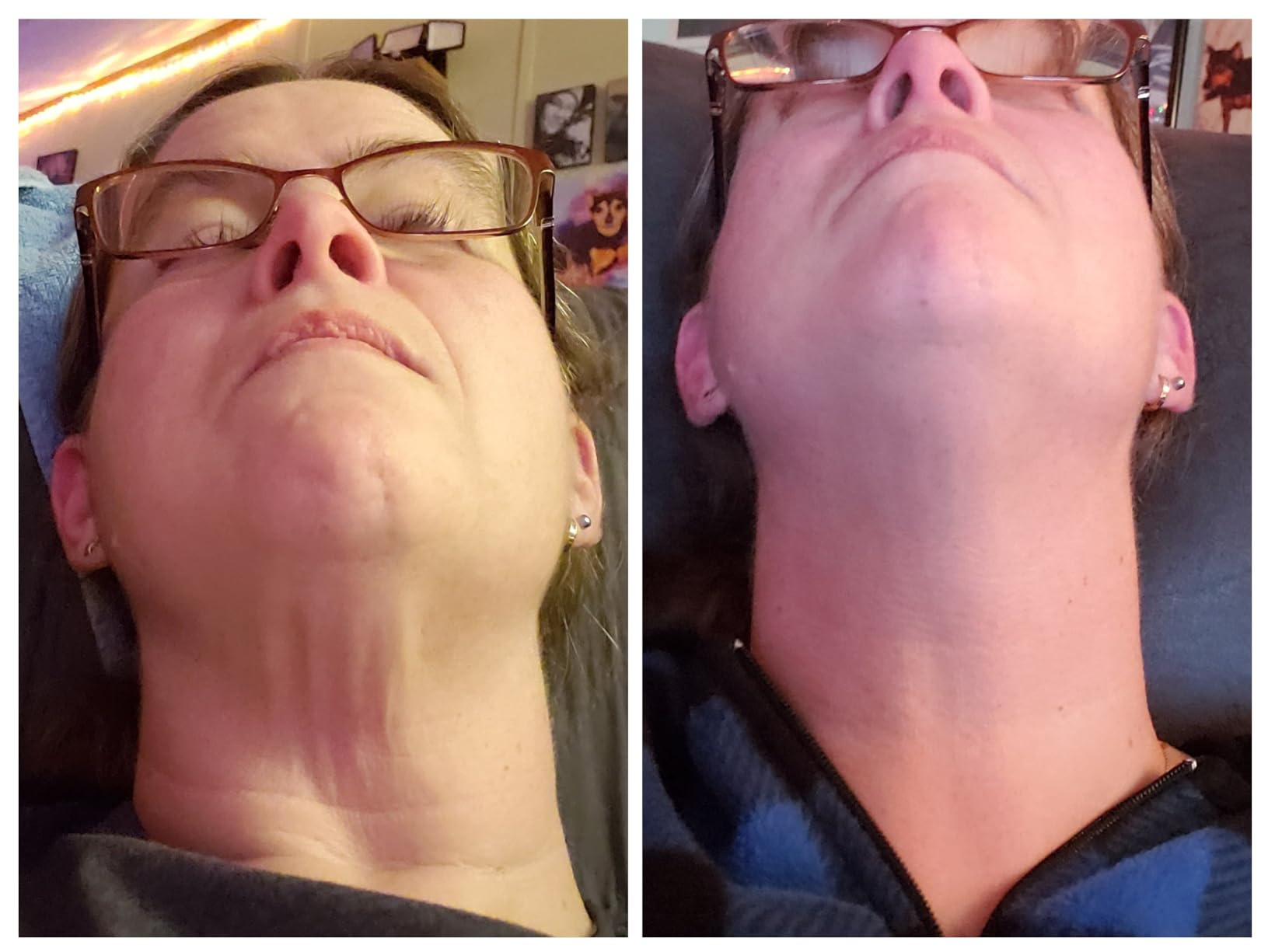 before/after of reviewer's cervix  showing smoother skin