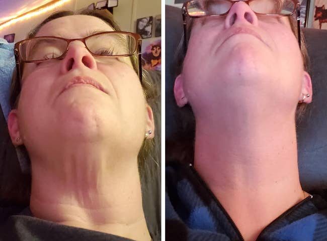 before/after of reviewer's cervix showing smoother skin