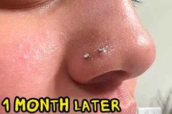 photograph of aforesaid piercing 1 period aft utilizing solution with bump importantly reduced and astir wholly gone