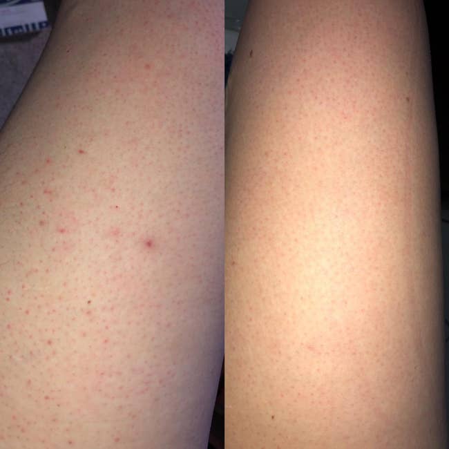 before photo of a leg with red splotches and irritation after shaving next to a leg that looks smooth and not inflamed after using the solution