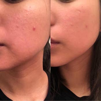 on left: reviewer's cheek with some pimples and bumpy texture. on right: same cheek with a smoother appearance and less visible pimples after using the face roller