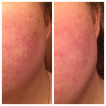 reviewer's before and after of jawline with peach fuzz