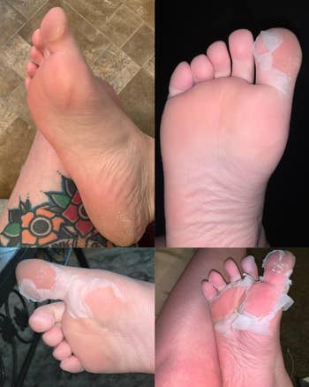 a reviewer's progression showing their foot with progressively more peeling