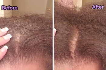 Reviewer's scalp before with dandruff and after using product with no dandruff