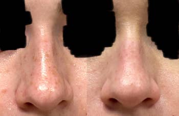 Before and aft  images showing a nose, highlighting changes successful  tegument  texture