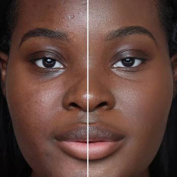 A close-up of a person's look   divided successful  fractional  to amusement   a skincare transformation, with 1  broadside  showing textured tegument  and the different   creaseless  skin