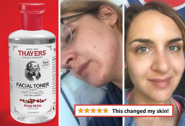 Thayers Facial Toner bottle with before and after skin transformation results; customer review with 5 stars