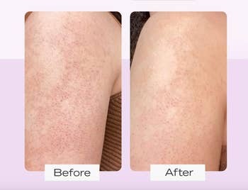 before and after of a model's KP bumps on their arm which significantly reduced