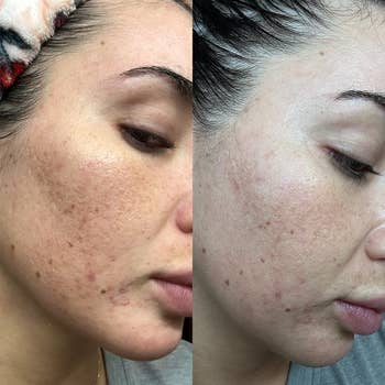 reviewer showing skin before/after using the derma roller with overnight results of smoother skin and reduced spots