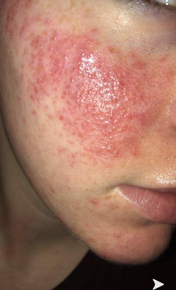 reviewer photo of their red and bumpy cheek before using the solution
