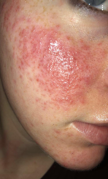 reviewer photo of their red and bumpy cheek before using the solution
