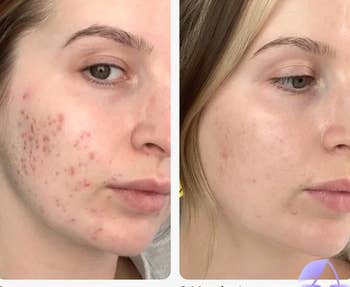 A model with significant redness and blemishes before using the serum, and after eight months of using it, with glowing, clear skin
