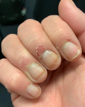 reviewers damaged, cut up cuticles