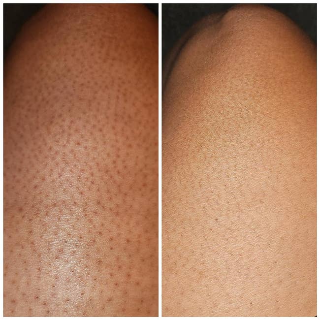 left: a reviewer with red bumps on their thigh / right: same reviewer with the appearance of bumps significantly reduced 