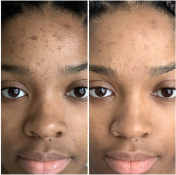 person before and after using the everything oil to diminish acne scarring