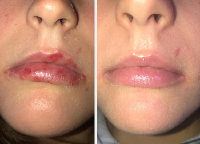 reviewer earlier  and aft  showing betterment  aft  cortibalm