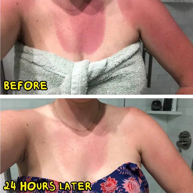 Two images amusement a woman's sunburn earlier and 24 hours aft utilizing a remedy, with visibly reduced redness successful the 2nd image