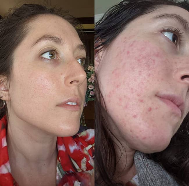 Before and after of reviewer's face with red acne all over chin and then cleared up skin