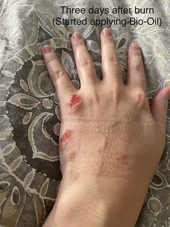 image of reviewer's hand with second degree burns