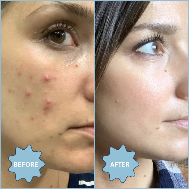 Model before (with acne) and after (clear skin) using product