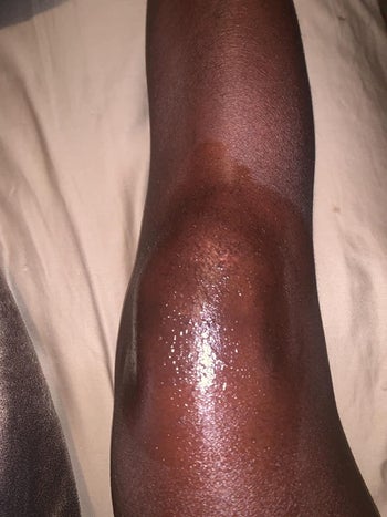 reviewer's knee with oil on it, almost entirely healed