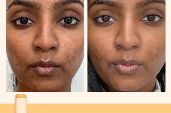 model before and after using Superhue for seven days with dark spots lightened